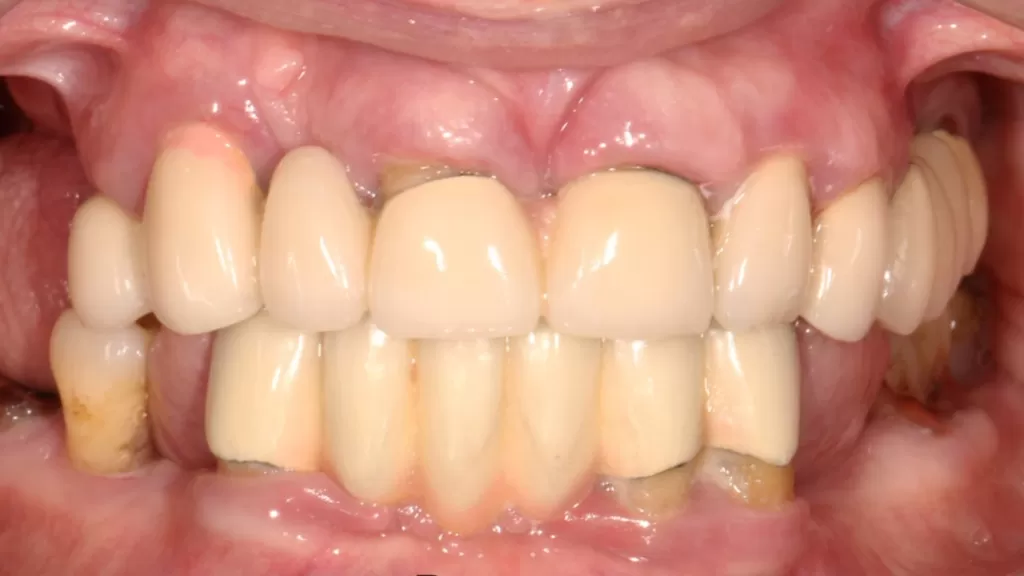 Так выглядят зубы после длительного воздействия бюгельных протезов